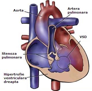 Stenoza pulmonara